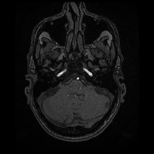 Basilar top and left middle cerebral artery aneurysm (Radiopaedia 61965-70031 Axial MRA 28).jpg