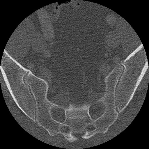 Benign post-traumatic pseudopneumoperitoneum (Radiopaedia 71199-81495 Axial bone window 300).jpg