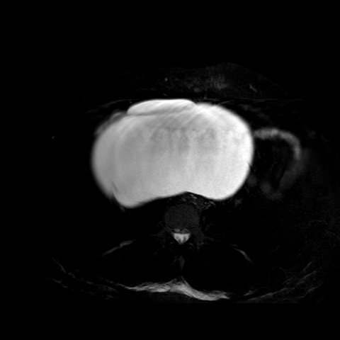 File:Benign seromucinous cystadenoma of the ovary (Radiopaedia 71065-81300 T2 SPAIR 20).jpg