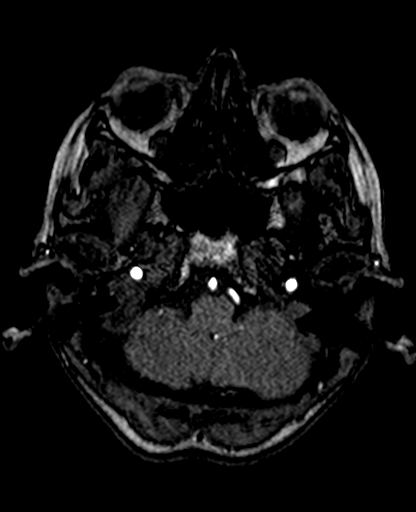 Berry aneurysm of the terminal internal carotid artery (Radiopaedia 88286-104918 Axial TOF 59).jpg