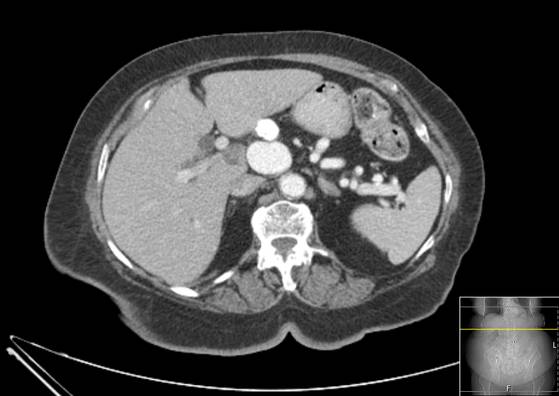 Bicameral celiacomesenteric aneurysm (Radiopaedia 55766-62327 A 17).jpg