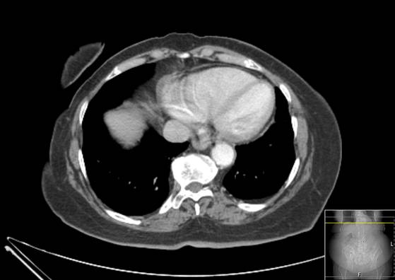 Bicameral celiacomesenteric aneurysm (Radiopaedia 55766-62327 A 2).jpg