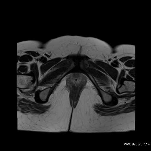 File:Bicornuate uterus- on MRI (Radiopaedia 49206-54297 Axial T2 18).jpg