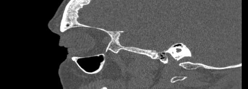 Bilateral Ectopic Infraorbital Nerves (Radiopaedia 49006-54084 Sagittal bone window 7).jpg