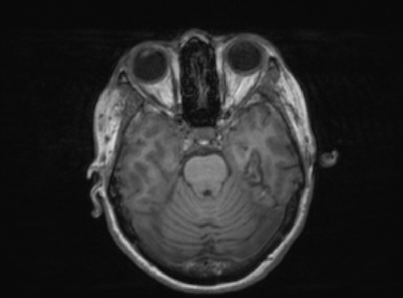 File:Bilateral PCA territory infarction - different ages (Radiopaedia 46200-51784 Axial T1 283).jpg