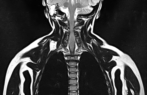 File:Bilateral Sprengel deformity with Klippel-Feil syndrome (Radiopaedia 66395-75650 Coronal T2 16).jpg