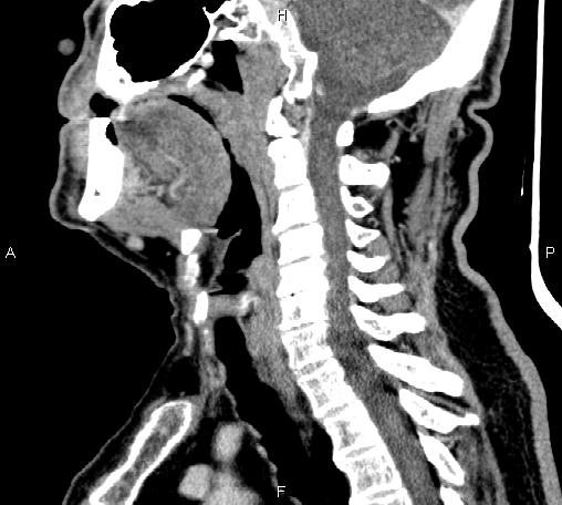 Bilateral Warthin tumors (Radiopaedia 84034-99263 D 39).jpg