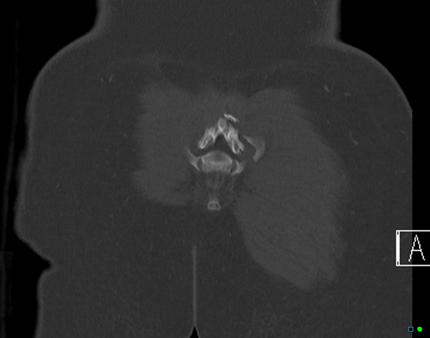 File:Bilateral acetabular fractures (Radiopaedia 79272-92308 Coronal bone window 44).jpg