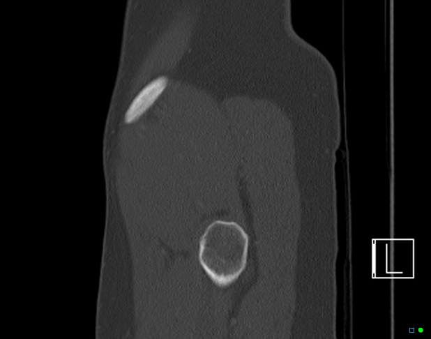 Bilateral acetabular fractures (Radiopaedia 79272-92308 Sagittal bone window 84).jpg