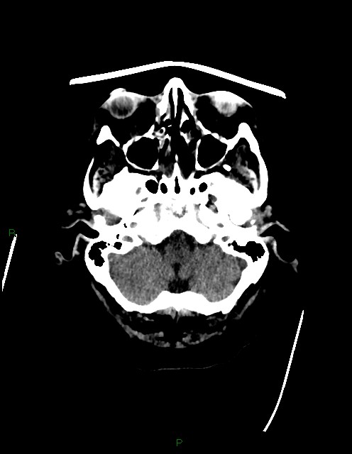 Bilateral acute middle cerebral artery territory infarcts (Radiopaedia 77319-89401 Axial non-contrast 12).jpg