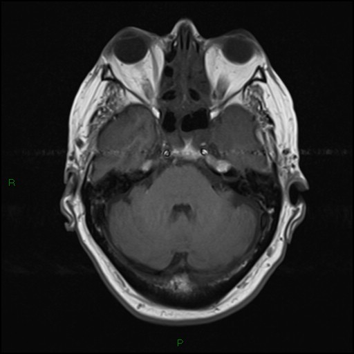 File:Bilateral acute middle cerebral artery territory infarcts (Radiopaedia 77319-89402 Axial T1 7).jpg