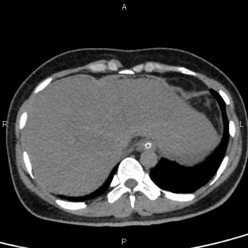 Bilateral adrenal gland hyperenhancement in pancreatitis (Radiopaedia 86642-102753 Axial non-contrast 13).jpg