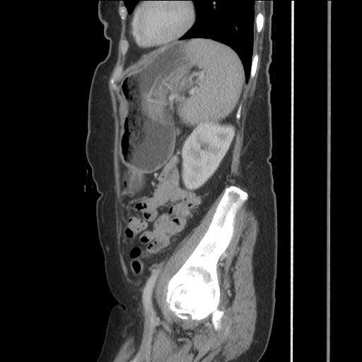File:Bilateral adrenal granulocytic sarcomas (chloromas) (Radiopaedia 78375-91007 C 102).jpg