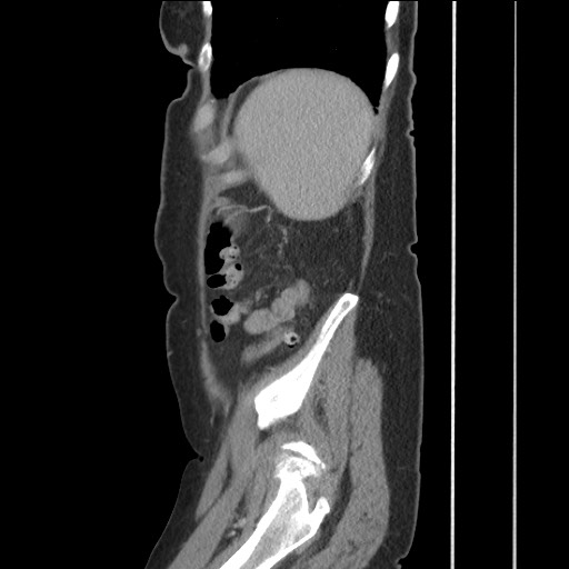 File:Bilateral adrenal granulocytic sarcomas (chloromas) (Radiopaedia 78375-91007 C 113).jpg
