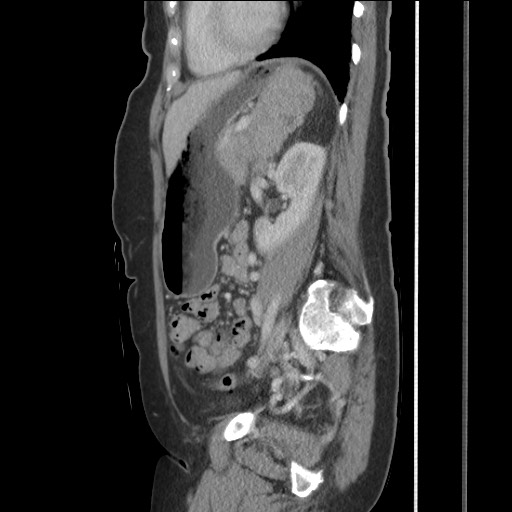 Bilateral adrenal granulocytic sarcomas (chloromas) (Radiopaedia 78375-91007 C 91).jpg