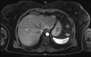 Bilateral adrenal myelolipoma (Radiopaedia 63058-71537 Axial T1 C+ fat sat 17).jpg