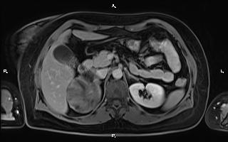 Bilateral adrenal myelolipoma (Radiopaedia 63058-71537 H 39).jpg