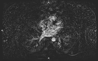 Bilateral adrenal myelolipoma (Radiopaedia 63058-71537 I 1).jpg
