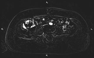 Bilateral adrenal myelolipoma (Radiopaedia 63058-71537 I 71).jpg