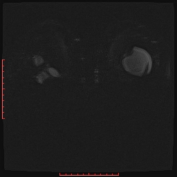 File:Bilateral breast implant rupture (Radiopaedia 24761-25027 PASTA Si IR 8).jpg