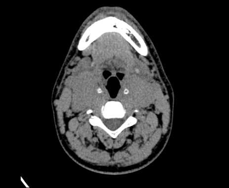 Bilateral carotid body tumors (Radiopaedia 61841-69870 Axial non-contrast 49).jpg