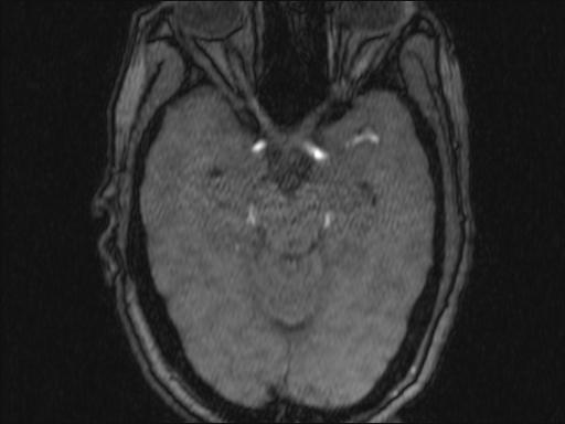 Bilateral carotid body tumors and right glomus jugulare tumor (Radiopaedia 20024-20060 Axial MRA 335).jpg
