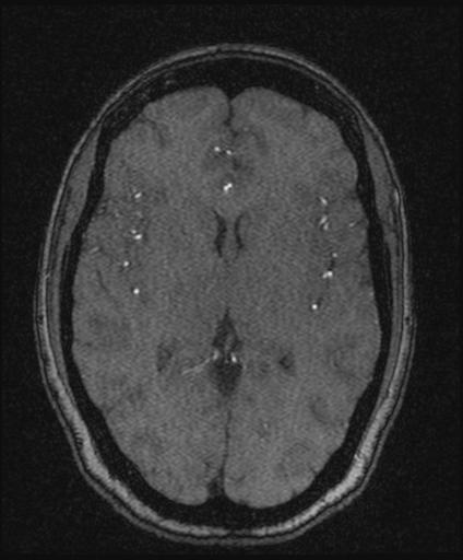 Bilateral carotid body tumors and right glomus jugulare tumor (Radiopaedia 20024-20060 Axial MRA 97).jpg
