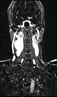 Bilateral carotid body tumors and right glomus jugulare tumor (Radiopaedia 20024-20060 MRA 103).jpg