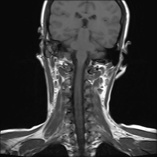 File:Bilateral carotid body tumors and right jugular paraganglioma (Radiopaedia 20024-20060 Coronal 17).jpg