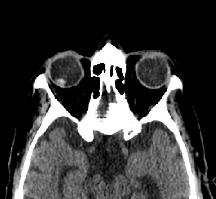 Bilateral ectopia lentis (Radiopaedia 89889-107013 Axial non-contrast 33).jpg