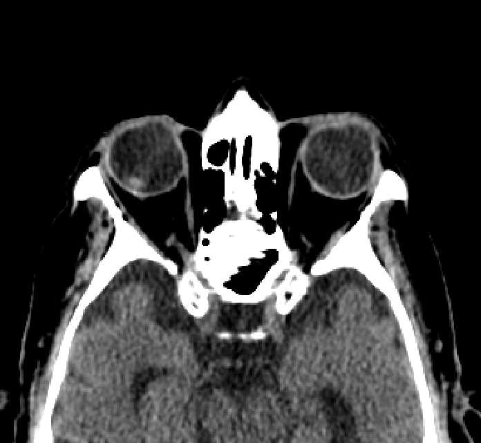 Bilateral ectopia lentis (Radiopaedia 89889-107013 Axial non-contrast 36).jpg
