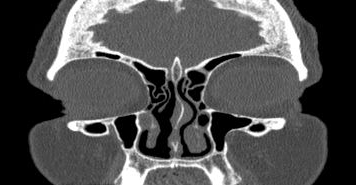 File:Bilateral ectopic infraorbital nerves (Radiopaedia 49006-54084 Coronal 56).png
