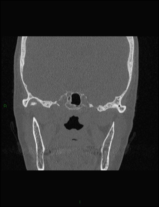 Bilateral frontal mucoceles (Radiopaedia 82352-96454 Coronal 257).jpg