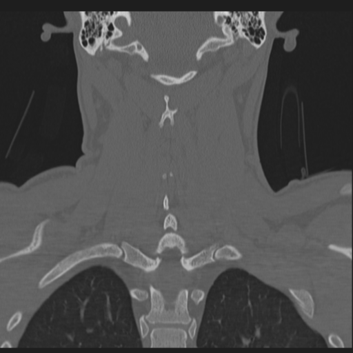 Bilateral locked facets (Radiopaedia 33850-35016 Coronal bone window 62).png