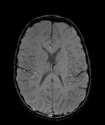 Bilateral mesial temporal polymicrogyria (Radiopaedia 76456-88181 Axial SWI 41).jpg
