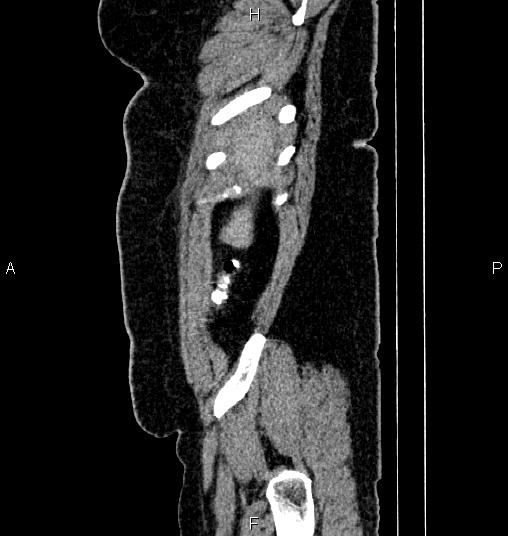 Bilateral ovarian dermoid cysts (Radiopaedia 85785-101603 D 2).jpg