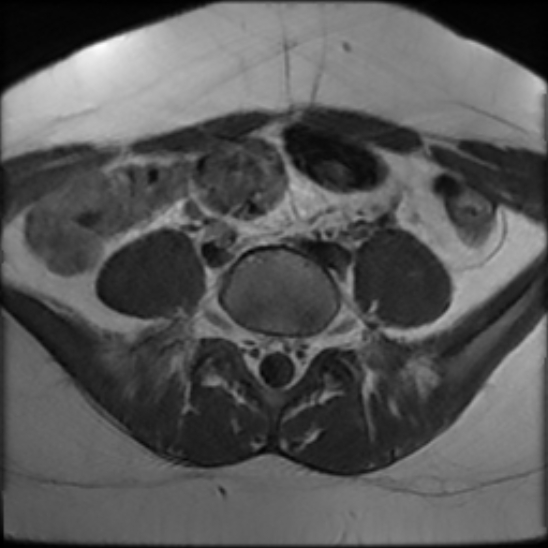 File:Bilateral ovarian fibrothecomas - adolescent (Radiopaedia 86604-102707 Axial T1 3).jpg