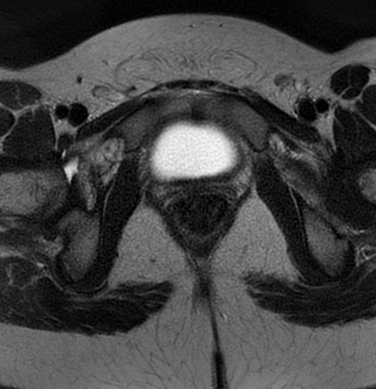 File:Bilateral ovarian fibrothecomas - adolescent (Radiopaedia 86604-102707 Axial T2 40).jpg