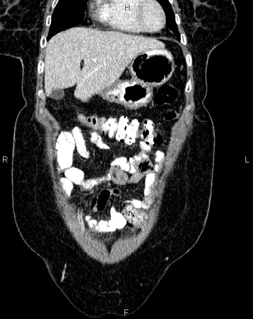 Bilateral ovarian serous cystadenocarcinoma (Radiopaedia 86062-101989 D 3).jpg