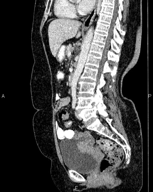 Bilateral ovarian serous cystadenocarcinoma (Radiopaedia 86062-101989 E 44).jpg