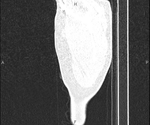 Bilateral pulmonary AVM (Radiopaedia 83134-97505 Sagittal lung window 9).jpg