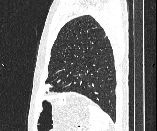 File:Bilateral pulmonary AVM (Radiopaedia 83134-97505 Sagittal lung window 91).jpg