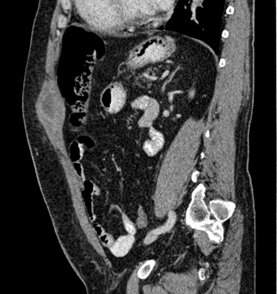 Bilateral rectus sheath hematomas (Radiopaedia 50778-56252 B 52).jpg