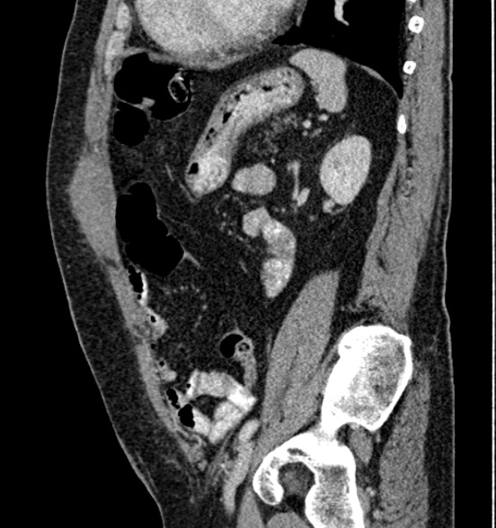 Bilateral rectus sheath hematomas (Radiopaedia 50778-56252 B 55).jpg
