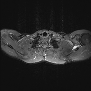 File:Bilateral spinoglenoid notch ganglion cysts (Radiopaedia 29577-30082 Axial STIR 15).jpg