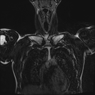 Bilateral spinoglenoid notch ganglion cysts (Radiopaedia 29577-30082 Coronal T2 28).jpg