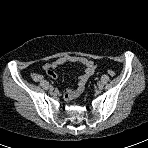 Bilateral staghorn calculi (Radiopaedia 59475-66842 Axial non-contrast 62).jpg