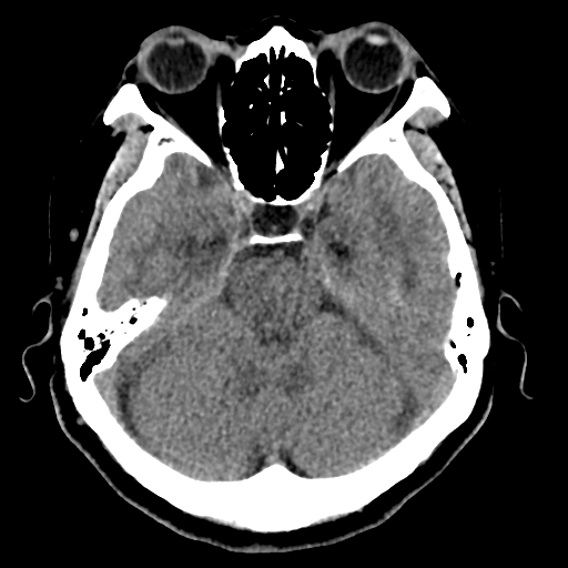 Bilateral subacute subdural hematoma (Radiopaedia 69240-79018 Axial non-contrast 15).jpg