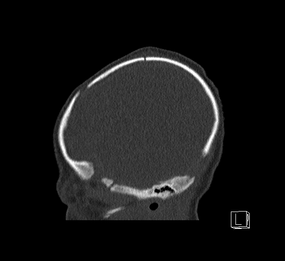 Bilateral subdural hemorrhage and parietal skull fracture (Radiopaedia 26058-26192 Sagittal bone window 83).png