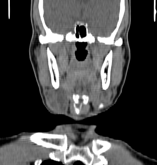 File:Bilateral submandibular sialolithiasis with sialadenitis (Radiopaedia 70721-80881 Coronal non-contrast 33).jpg